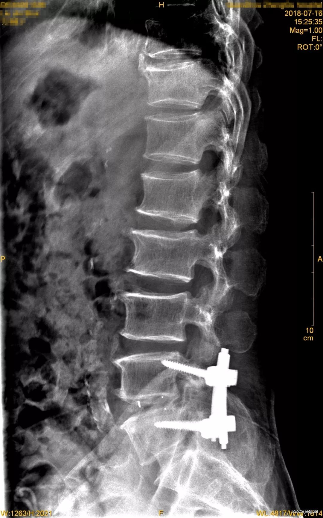 腰椎后路椎管减压植骨融合内固定手术纪实(2020.08.10) - 知乎