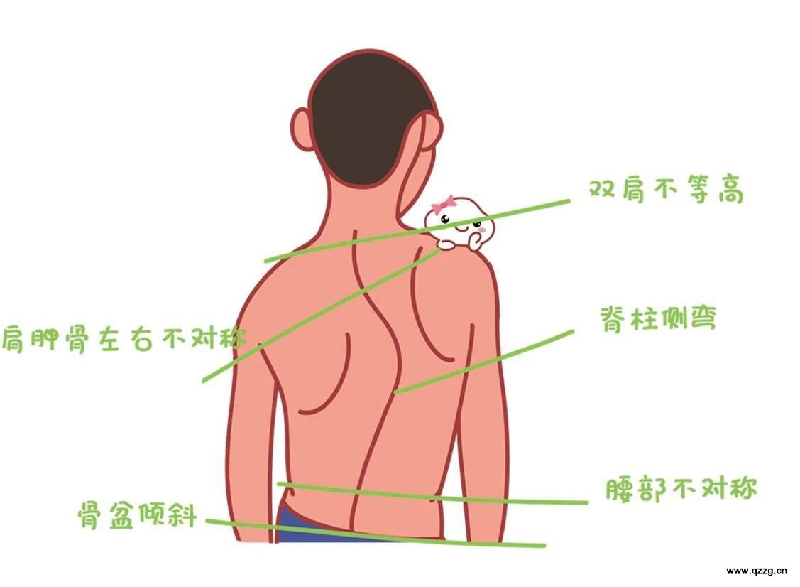 正骨科普 肩膀一高一低 妙龄女患上脊柱侧弯 福建中医药大学附属泉州市正骨医院